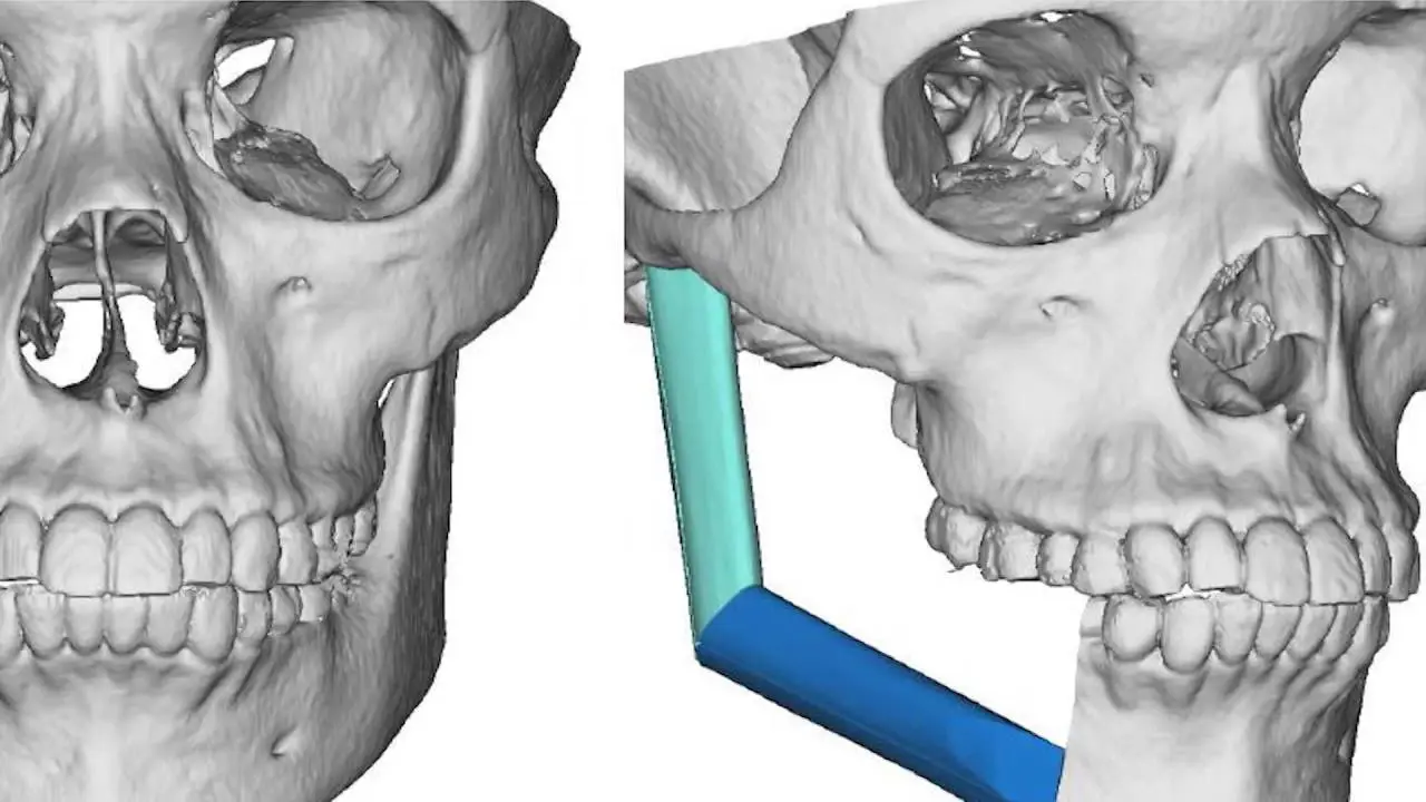 Department of Oral and Maxillofacial Surgery University of Maryland School of Dentistry Video Thumbnail